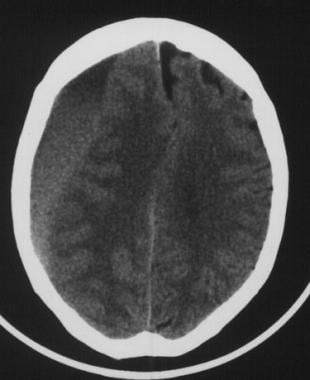 Subacute subdural hematoma. The crescent-shaped cl