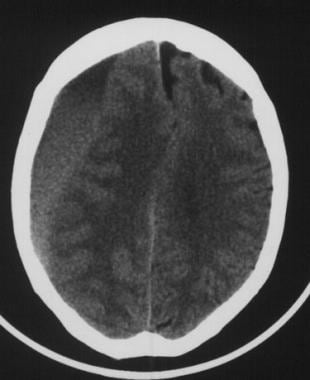 chronic subdural hematoma vs acute