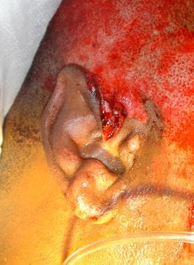 Lacerated ear. 