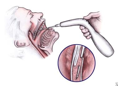 Two-piece mandibular advancement device without elastic retention