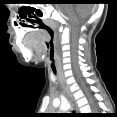 Sagittal contrasted CT image from the 3-year-old p