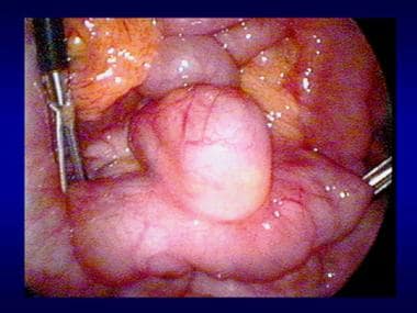 Laparoscopy in a patient with gastrointestinal ble