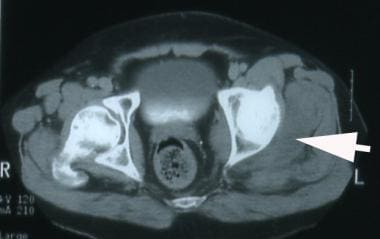 Sciatic Nerve Decompression: Background, Indications, Technical  Considerations