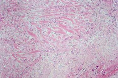 Histology of keloid demonstrating thick hyalinized