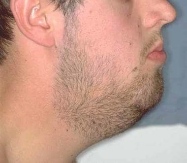 Profile view of a young adult with oral lymphangio
