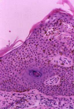Proliferating dendritic melanocytes in the prickle