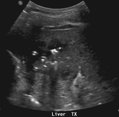 C-7: The patient developed frank abscess after a f