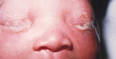 Severe purulent discharge and eyelid edema in a ne