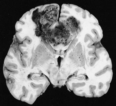 This typical untreated glioblastoma, here with the