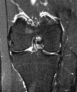 MRI scan of typical discoid meniscus. Image courte