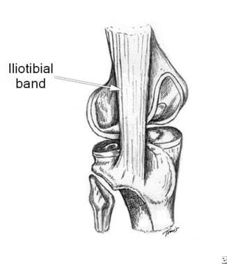 Iliotibial band at the lateral femoral epicondyle,