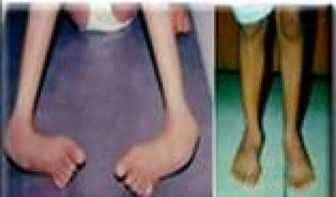 Surgical correction of rigid foot deformities by o