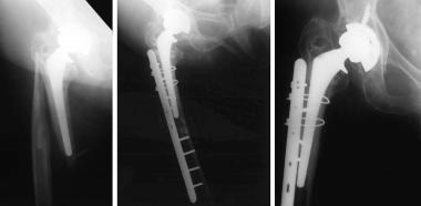 Fracture around stable prosthesis treated with sta