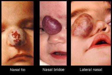 Types of nasal hemangiomas. 