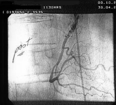 Cardiogenic shock. This coronary angiogram from a 