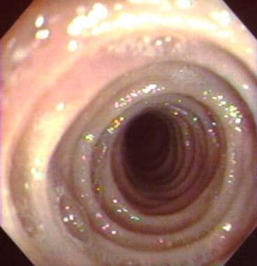 Multiple esophageal rings found throughout the ent