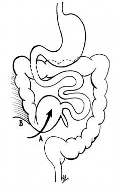 Cecal bascule. (A) Anterior folding of cecum. (B) 