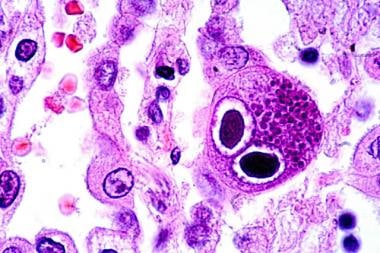 Hematoxylin-eosin–stained lung section showing typ