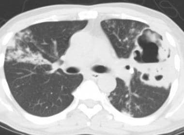 Axial chest computed tomography without intravenou