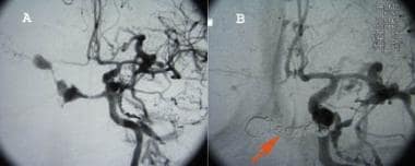 Panel A is an angiogram of caroticocavernous fistu