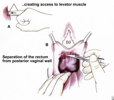 A large posterior vaginal wall cyst simulating rectocele: an account of an  unusual perplexing case - Document - Gale Academic OneFile