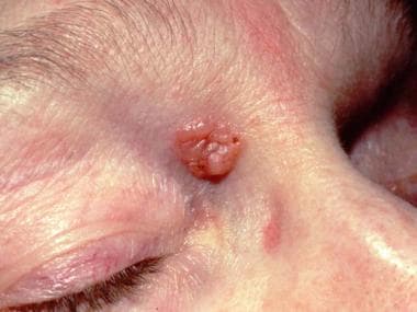 Nodular basal cell carcinoma appearing as a waxy, 