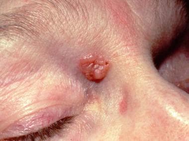 infiltrative basal cell carcinoma