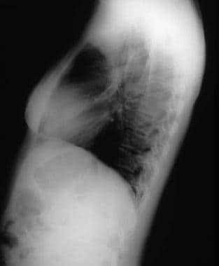 Lateral chest radiograph showing a carcinoid lung 