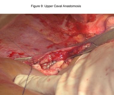 Liver transplantation. Upper caval anastomosis. 