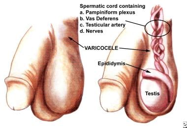 Varicocele: Risk Factors, Diagnosis and Treatment