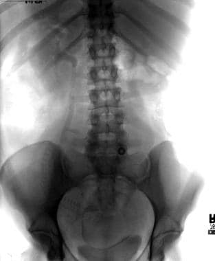 25-year-old pregnant woman with right lower quadra