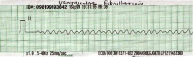 Rhythm strip showing ventricular fibrillation. 