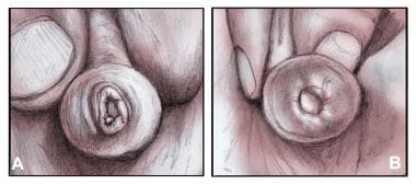 Physiologic phimosis versus pathologic phimosis. 