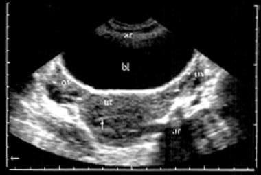 Transabdominal transverse view of the female pelvi