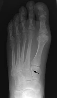 Fractures, foot. Subtle fracture of the first cune