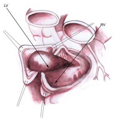 The left ventricular incision to enlarge the outfl