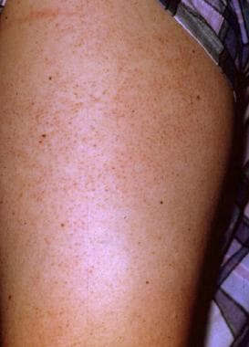 Keratosis pilaris occurs most commonly on the late