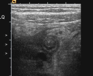 Ultrasonographic examination of the right lower qu
