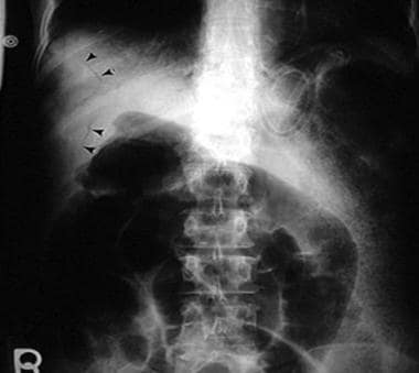 Pediatric Small Bowel Obstruction. A plain abdomin