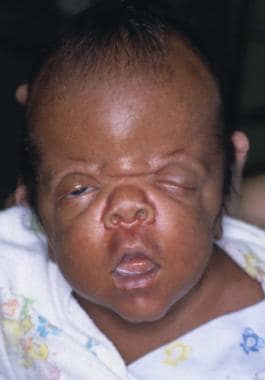 An infant with Apert syndrome is shown. Note the c