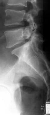 Lateral radiograph of the lumbar spine shows spond