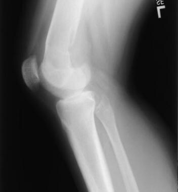 Lateral plain radiograph of the knee reveals an os