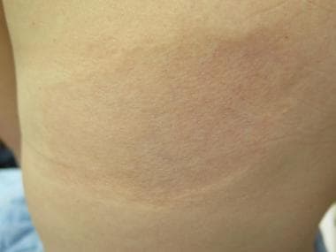 Single ovoid patch of atrophoderma on the back of 