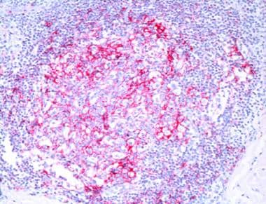 Follicle center cell lymphoma. Irregular pattern o
