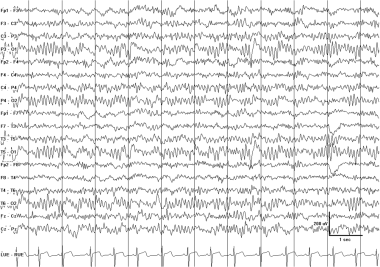 Focal EEG Waveform Abnormalities: Overview, Alterations in Normal ...