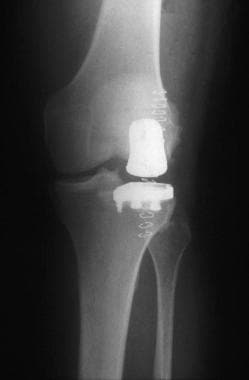 Same knee as above, treated with a lateral unicomp
