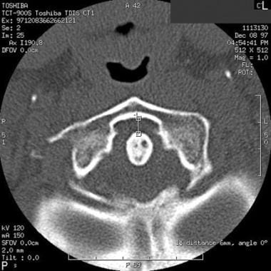 Axial CT scan of increased atlantodens interval. 