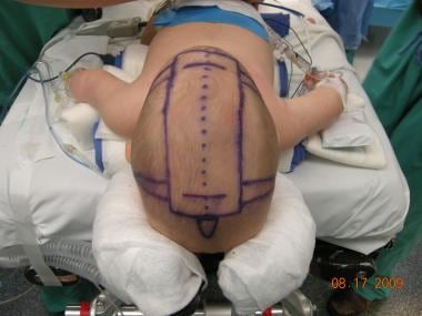 Preoperative picture of a 3-month-old child with a