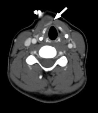 Axial contrast-enhanced CT shows a rim of enhancin