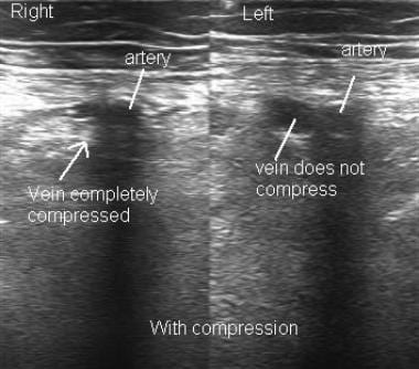 Ultrasonographic image of femoral vessels with com